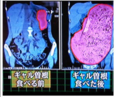 ギャル曽根は食後のお腹レントゲン画像が異常すぎ?謎の太らない理由は体質にあった? | もっちりタイム